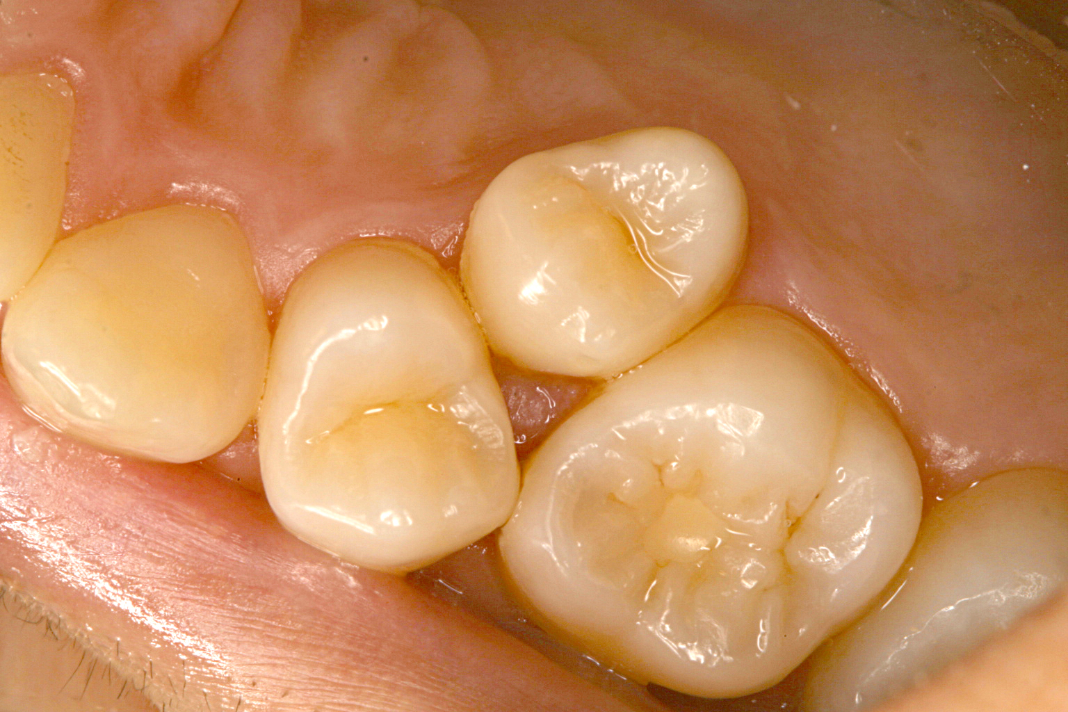 歯ならびをなおしたいのイメージ