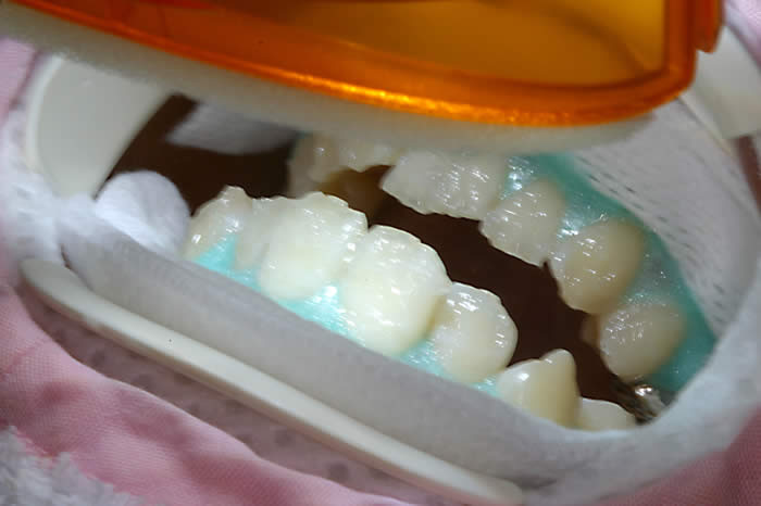 ホワイトニングって？