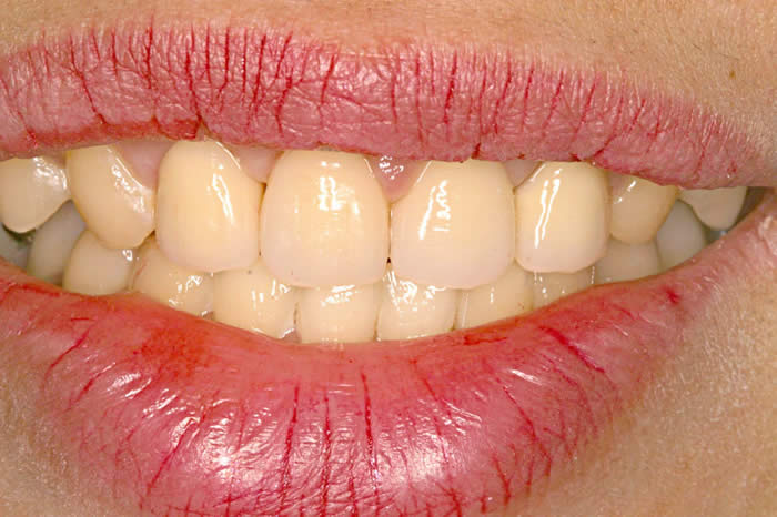 ホワイトニング中の写真